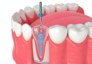 ENDODONCIJA